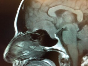 Tumors That Mimic Pituitary Adenomas Because Of Their Location