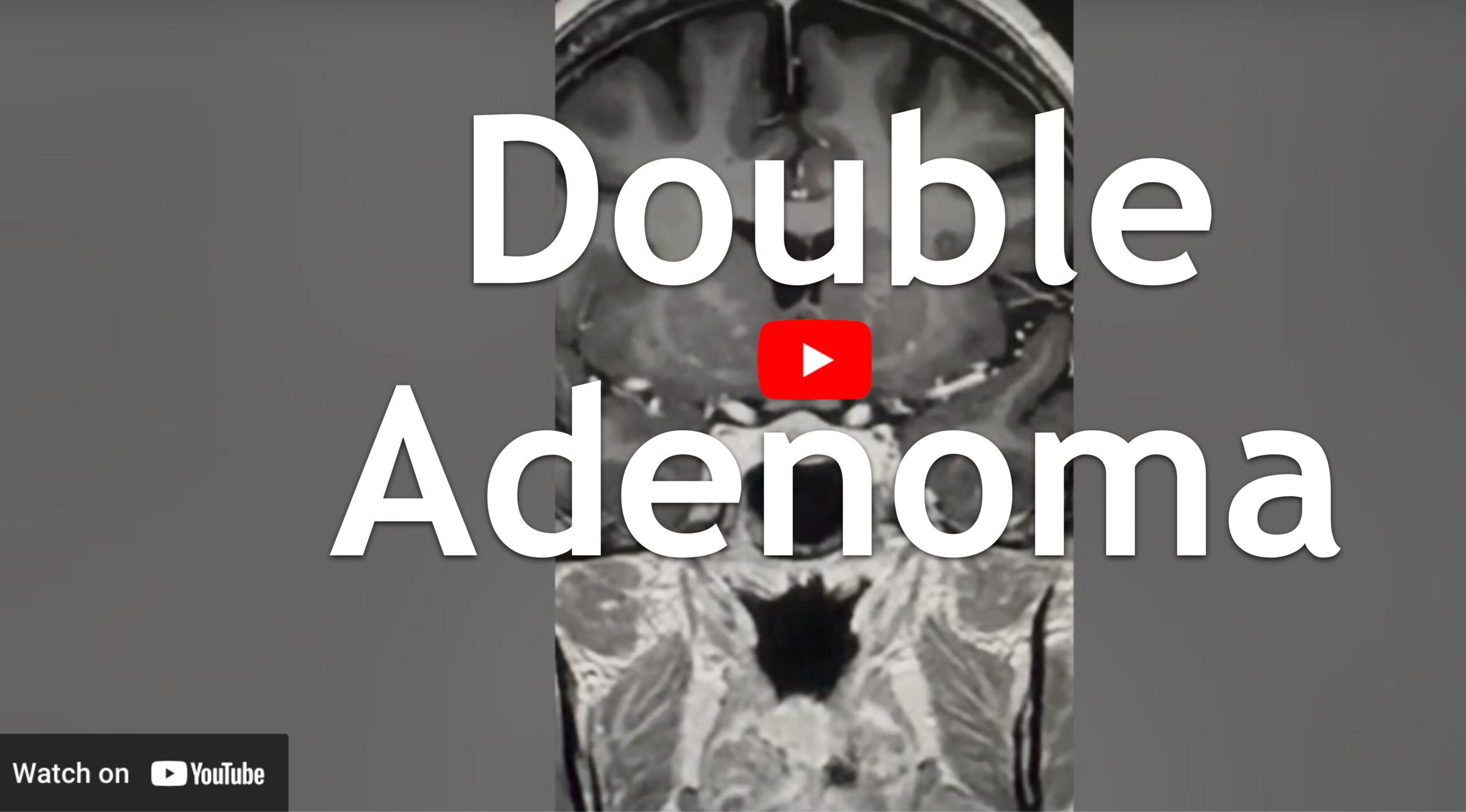 Double Pituitary Adenomas A Case From Dr Blevins Clinic Pituitary