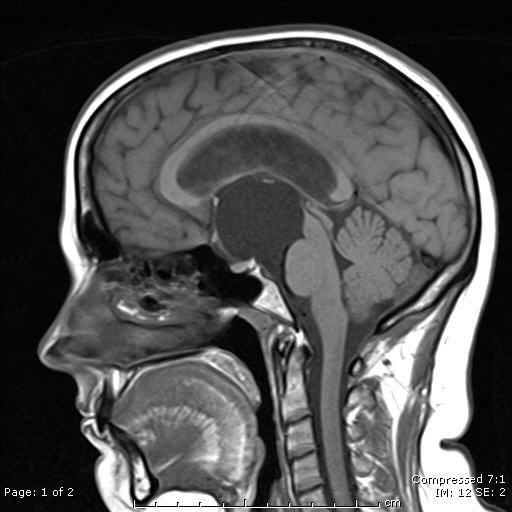 Pituitary Cysts Pituitary World News 7685