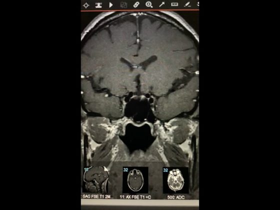 Pituitary Mri Educational Series The Normal Pituitary Gland Pituitary World News 3600