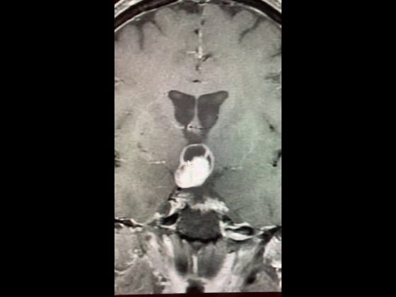 Pituitary Mri Educational Series Craniopharyngioma Pituitary World News 4310