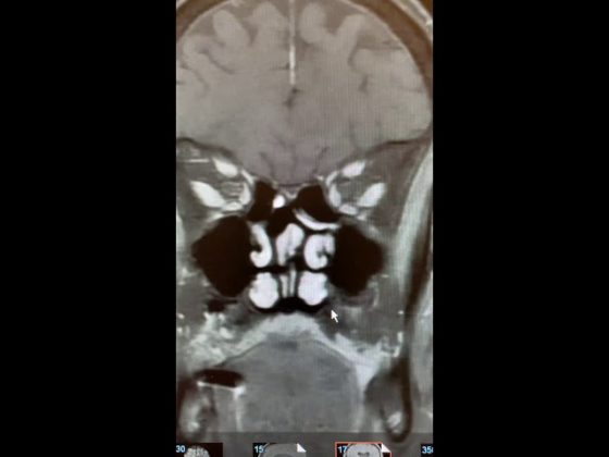 Pituitary Mri Educational Series Cystic Lesion In Sella Pituitary World News 0318