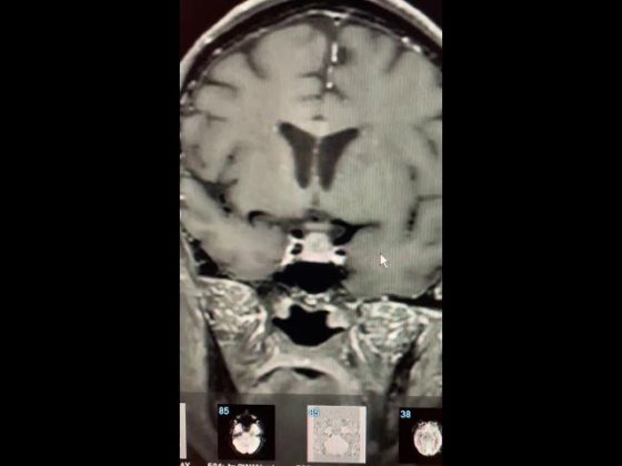 Pituitary Mri Educational Series A Metastasis To The Pituitary Region Pituitary World News 3951