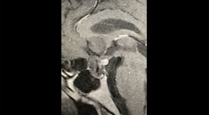 Pituitary MRI educational series: Growing supposed pituitary tumor in patient with hypopituitarism