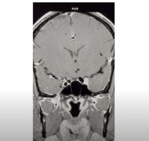 Pituitary MRI educational series: Normal Pituitary scan leads to other findings