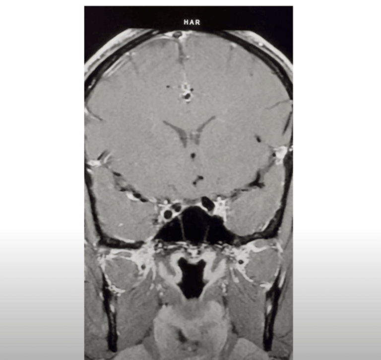 Pituitary Mri Educational Series Normal Pituitary Scan Leads To Other Findings Pituitary 2643