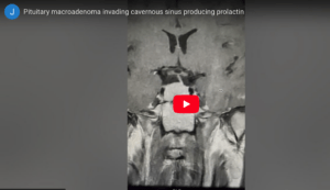 Pituitary MRI educational series: macroadenoma invading cavernous sinus producing prolactin